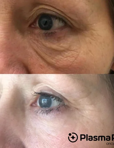 blefaroplastia con plasmapen.