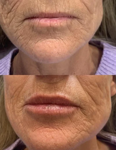 hidratación de labios