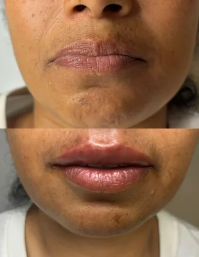 aumento de labios