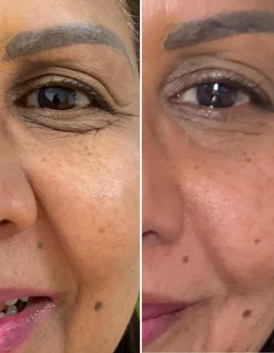 tratamiento ojeras