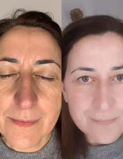 peeling químico