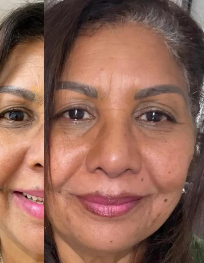tratamiento de ojeras